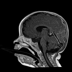 File:Neurofibromatosis type 1 (Radiopaedia 30089-30671 Sagittal T1 C+ 8).jpg
