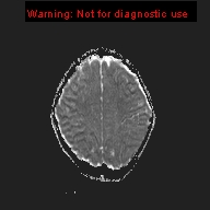 File:Neurofibromatosis type 1 with optic nerve glioma (Radiopaedia 16288-15965 Axial ADC 6).jpg