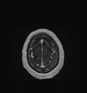 Neurofibromatosis type 2 (Radiopaedia 79097-92049 Axial T1 C+ 177).jpg