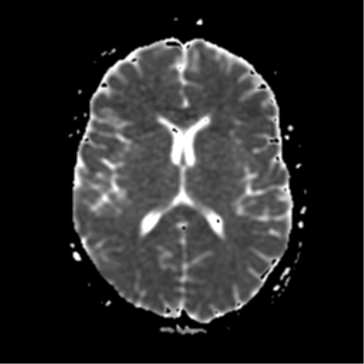 File:Neurofibromatosis type 2 - bilateral acoustic neuromata (Radiopaedia 40060-42566 Axial ADC 12).png