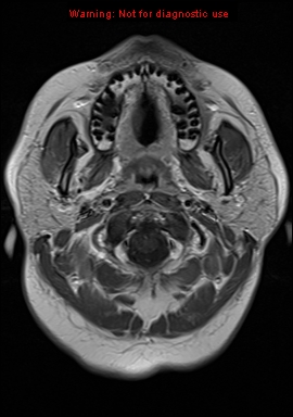 File:Neuroglial cyst (Radiopaedia 10713-11184 Axial T1 C+ 23).jpg