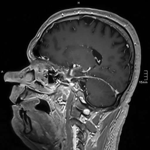 Neurosarcoidosis - involvement of the mesial temporal lobes (Radiopaedia 67429-76820 Sagittal T1 C+ 68).jpg