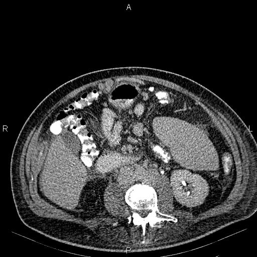 Non Hodgkin lymphoma in a patient with ankylosing spondylitis (Radiopaedia 84323-99621 Axial C+ delayed 37).jpg