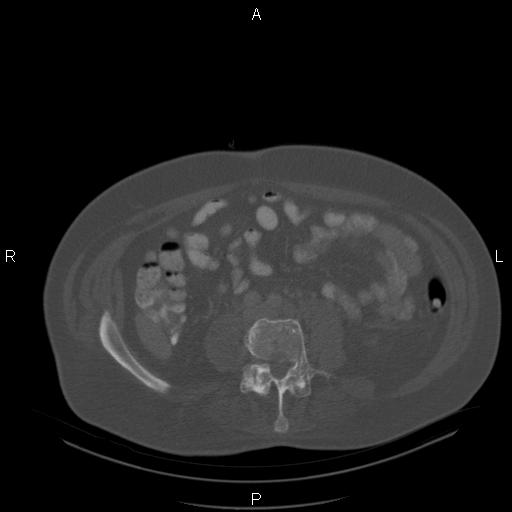 Non Hodgkin lymphoma in a patient with ankylosing spondylitis (Radiopaedia 84323-99624 Axial bone window 46).jpg