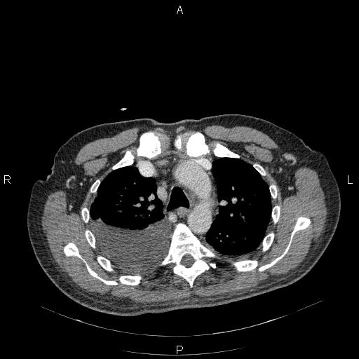 File:Non Hodgkin lymphoma in a patient with ankylosing spondylitis (Radiopaedia 84323-99624 B 10).jpg