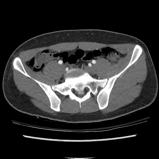File:Normal CT angiogram of pelvis (Radiopaedia 45390-49430 A 27).jpg