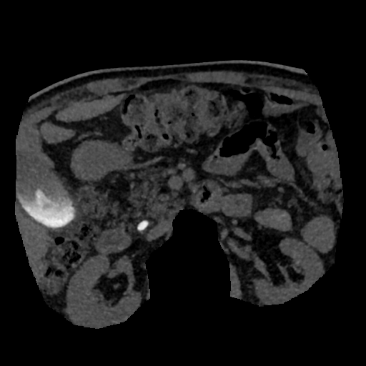 File:Normal CT intravenous cholangiogram (Radiopaedia 38199-40208 Axial IVC (MIP) 21).png