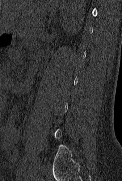 File:Normal CT lumbar spine (Radiopaedia 53981-60118 Sagittal bone window 77).jpg