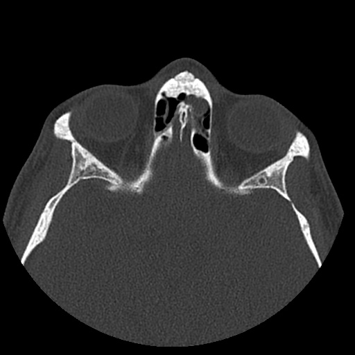 Normal CT paranasal sinuses (Radiopaedia 42286-45390 Axial bone window 38).jpg