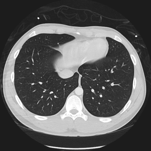Normal CT pulmonary veins (pre RF ablation) (Radiopaedia 41748-44702 Axial lung window 47).png