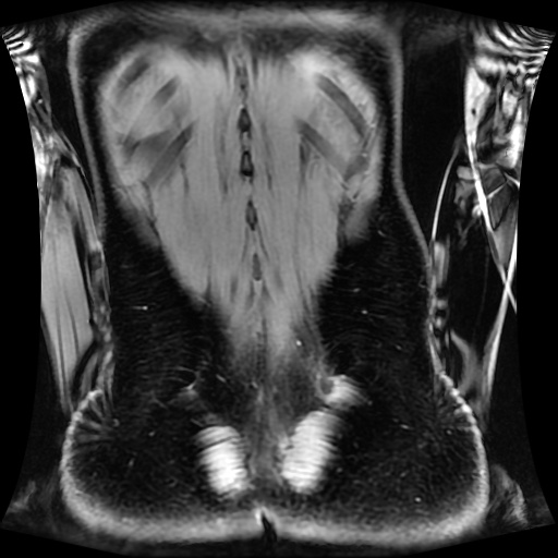 Normal MRI abdomen in pregnancy (Radiopaedia 88001-104541 M 121).jpg