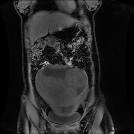 Normal MRI abdomen in pregnancy (Radiopaedia 88001-104541 M 43).jpg