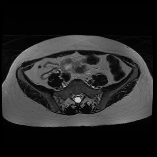 Normal MRI abdomen in pregnancy (Radiopaedia 88005-104548 Axial T2 16).jpg