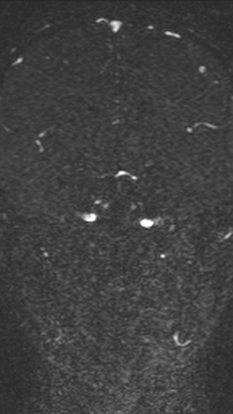 Normal MRI brain with MRV- teenager (Radiopaedia 49425-54553 Coronal MRV 127).jpg