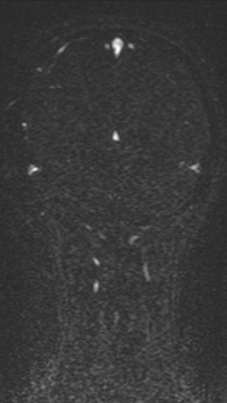 Normal MRI brain with MRV- teenager (Radiopaedia 49425-54553 Coronal MRV 190).jpg