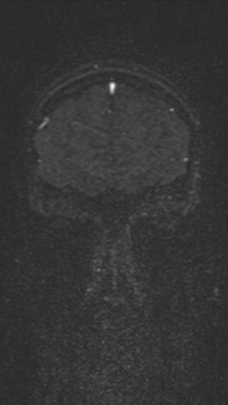 Normal MRI brain with MRV- teenager (Radiopaedia 49425-54553 Coronal MRV 51).jpg