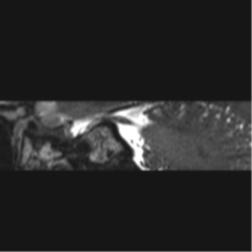 Normal MRI internal auditory canal (Radiopaedia 41613-44525 C 42).png