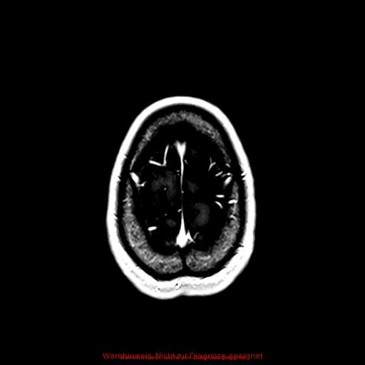 Normal adult brain MRI (non-enhanced and contrast-enhanced) (Radiopaedia 75262-86379 Axial T1 C+ 164).jpg