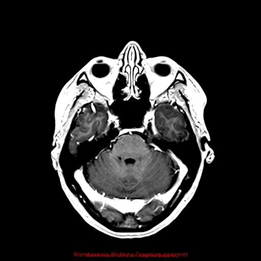 Normal adult brain MRI (non-enhanced and contrast-enhanced) (Radiopaedia 75262-86379 Axial T1 C+ 76).jpg