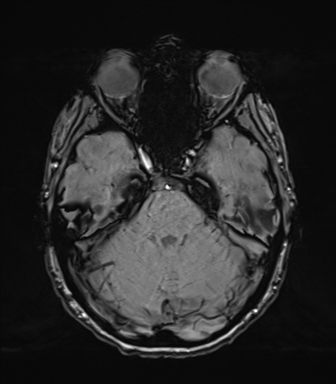 Normal brain MRI (TLE protocol) (Radiopaedia 40748-43405 Axial SWI 27).png