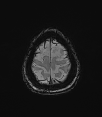 Normal brain MRI (TLE protocol) (Radiopaedia 40748-43405 Axial SWI 80).png
