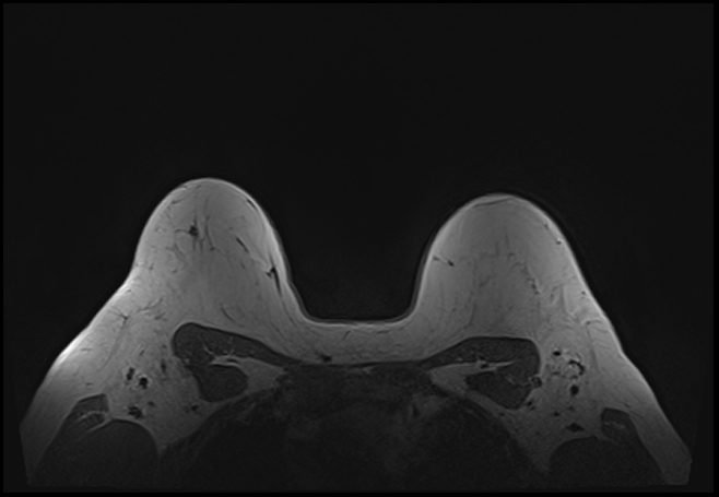 File:Normal breast MRI - dense breasts (Radiopaedia 80454-93850 Axial T1 185).jpg