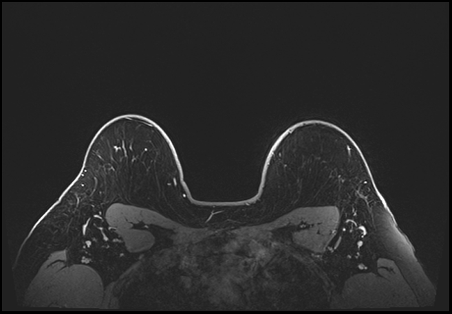 Normal breast MRI - dense breasts (Radiopaedia 80454-93850 C 190).jpg