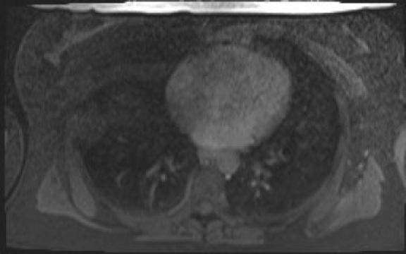 File:Normal hepatobiliary phase liver MRI (Radiopaedia 58968-66230 A 3).jpg