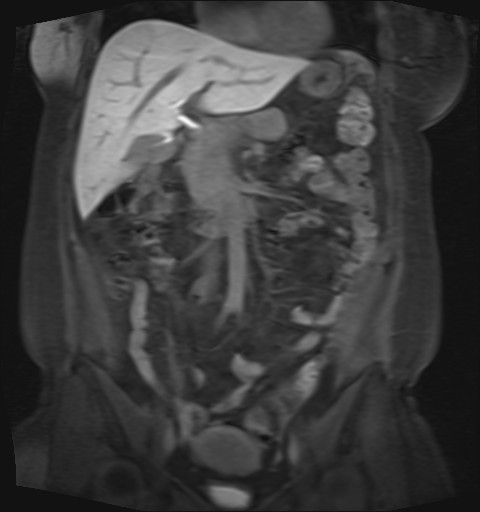File:Normal hepatobiliary phase liver MRI (Radiopaedia 58968-66230 B 32).jpg
