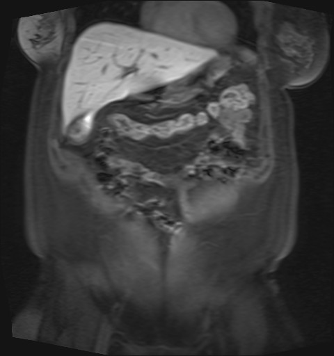 File:Normal hepatobiliary phase liver MRI (Radiopaedia 58968-66230 B 39).jpg