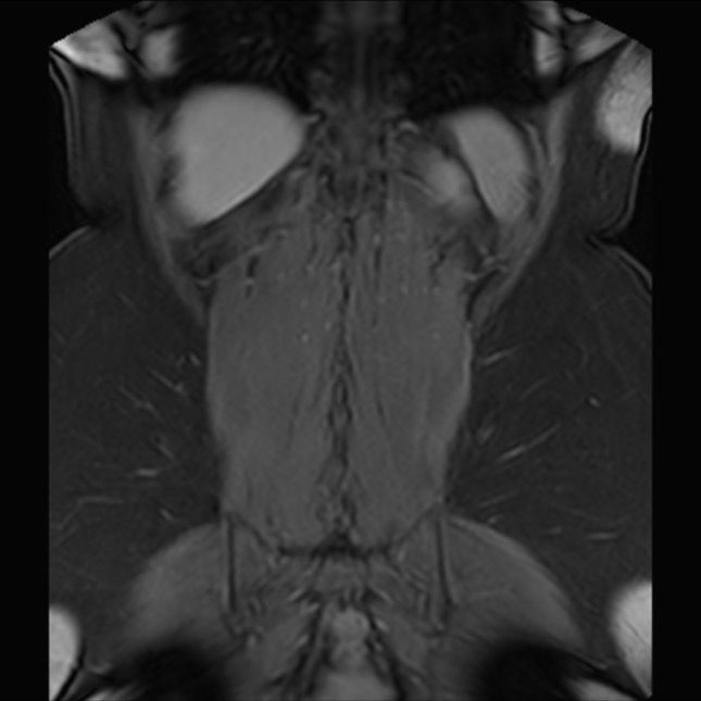 Normal liver MRI with Gadolinium (Radiopaedia 58913-66163 P 73).jpg