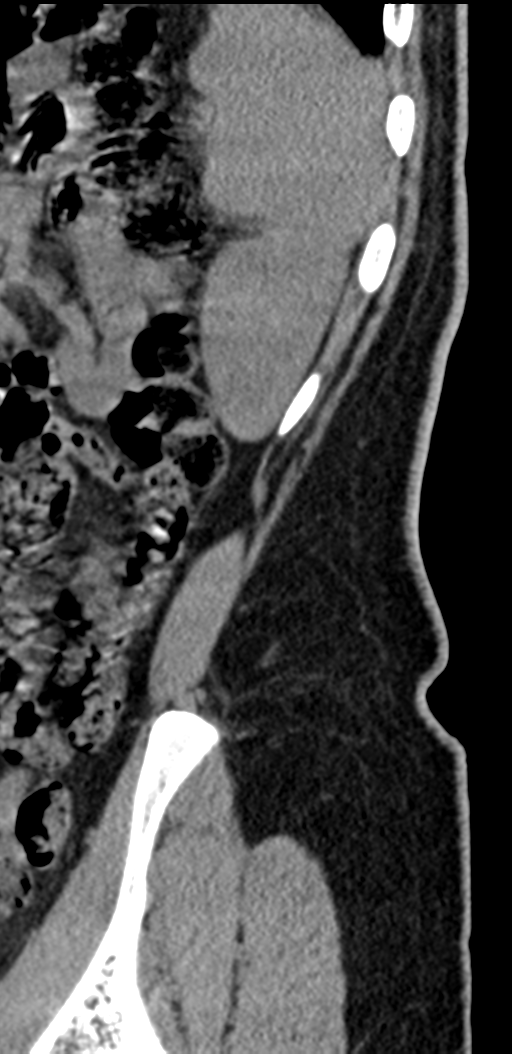 Normal lumbosacral CT (Radiopaedia 37923-39867 E 3).png
