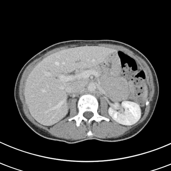 File:Normal multiphase CT liver (Radiopaedia 38026-39996 C 27).jpg
