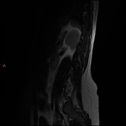 File:Normal spine MRI (Radiopaedia 77323-89408 Sagittal T2 13).jpg