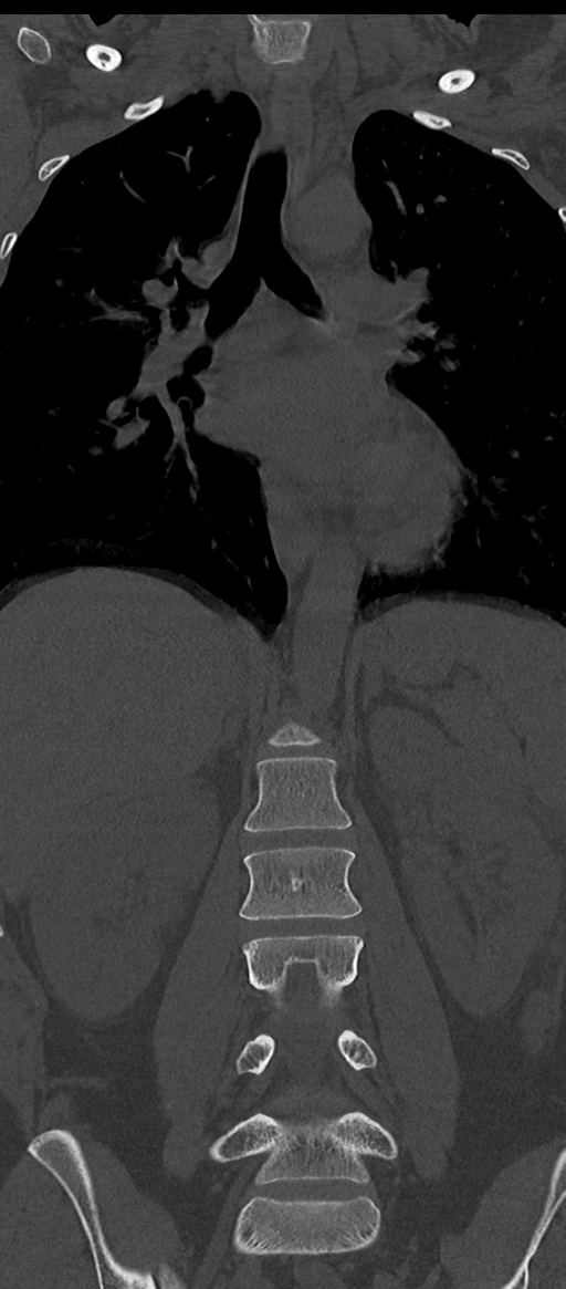 Normal thoracolumbar spine (Radiopaedia 43822-47309 Coronal bone window 40).png