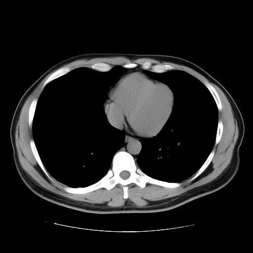 File:Obstructing ureteric calculus (Radiopaedia 18615-18514 Axial non-contrast 3).jpg