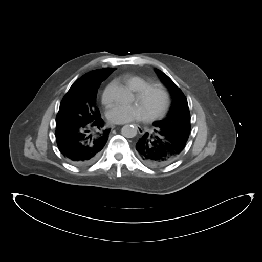 File:Obstructive pyelonephritis (Radiopaedia 46411-50844 Axial non-contrast 3).png