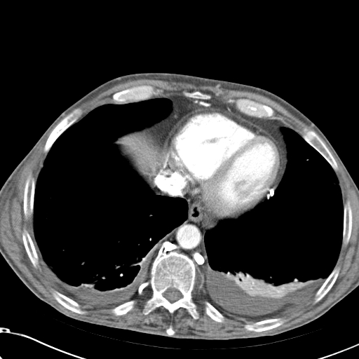 File:Obstructive superior vena cava tumor thrombus (Radiopaedia 28046-28306 A 43).jpg