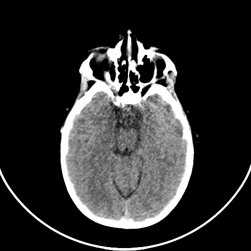 Occipital encephalocele (Radiopaedia 87339-103636 Axial non-contrast 31).jpg