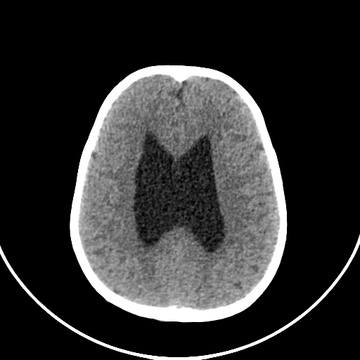 Occipital encephalocele (Radiopaedia 87339-103636 Axial non-contrast 57).jpg