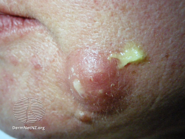 File:Palpating an epidermoid cyst (DermNet NZ lesions-cyst17).jpg