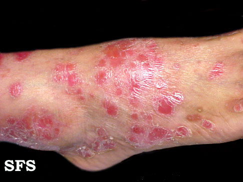File:Psoriasis (Dermatology Atlas 2).jpg
