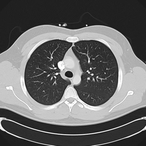 'Bovine' aortic arch (Radiopaedia 33554-34637 Axial lung window 21).png