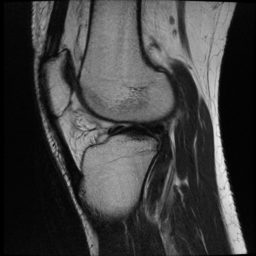 File:ACL acute full thickness tear - deep lateral femoral sulcus sign (Radiopaedia 38594-40740 Sagittal T2 14).jpg