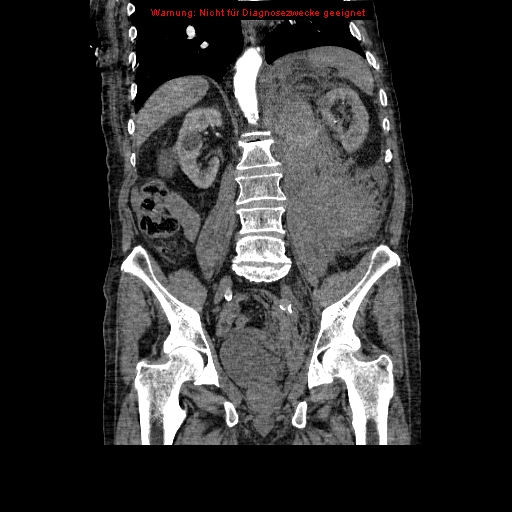 File:Abdominal aortic aneurysm- extremely large, ruptured (Radiopaedia 19882-19921 Coronal C+ arterial phase 65).jpg