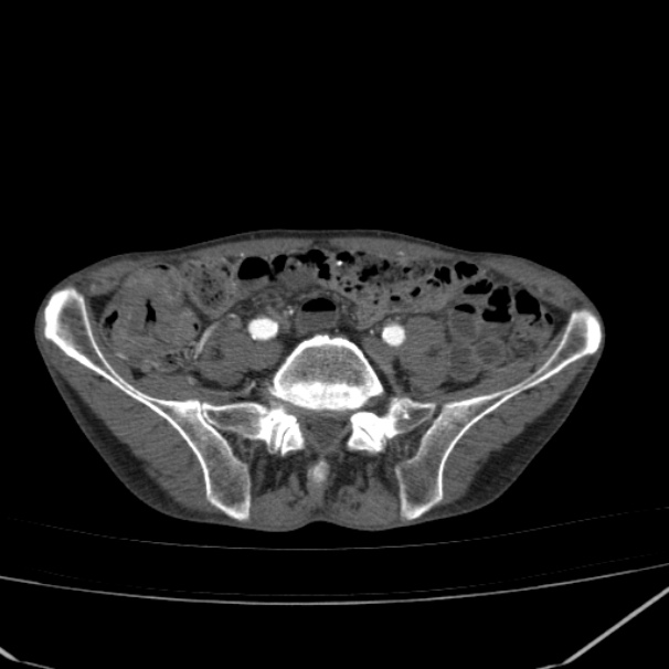 Abdominal aortic aneurysm (Radiopaedia 23703-23856 Axial C+ arterial phase 68).jpg