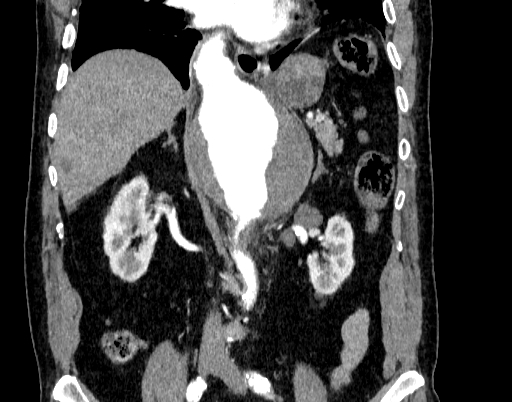 Abdominal aortic aneurysm (Radiopaedia 67117-76452 Coronal C+ arterial phase 54).jpg