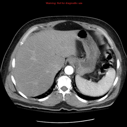 Abdominal aortic aneurysm (Radiopaedia 8190-9038 Axial C+ arterial phase 15).jpg