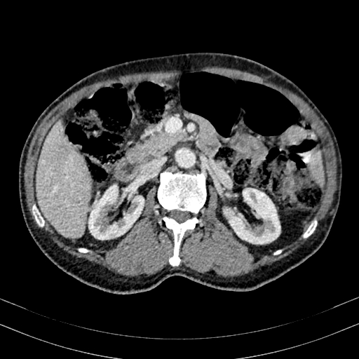 Abdominal aortic aneurysm (Radiopaedia 83581-98689 Axial C+ portal venous phase 46).jpg