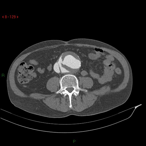 Abdominal aortic aneurysm rupture with aortocaval fistula (Radiopaedia 14897-14841 Axial C+ arterial phase 129).jpg